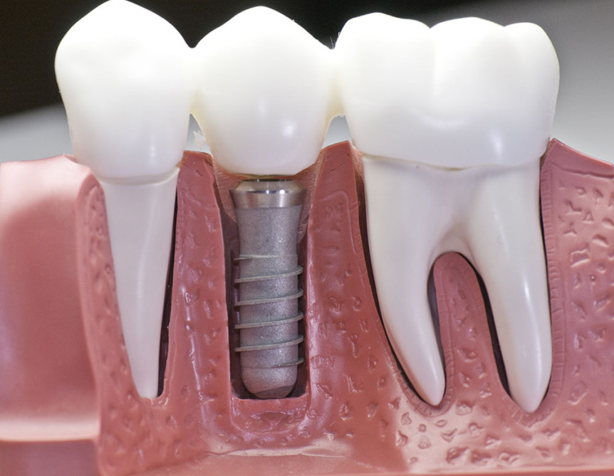 Почему не стоит бояться зубных имплантатов