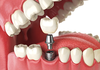 Преимущества зубных имплантатов